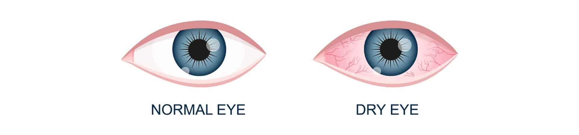 Dry Eye - Eye Care Institute