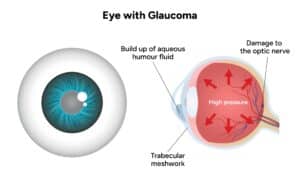 Diagram depicts a healthy eye beside an eye with glaucoma and related ocular pressure